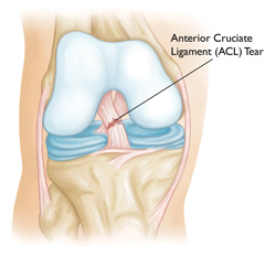 ACL-Rupture